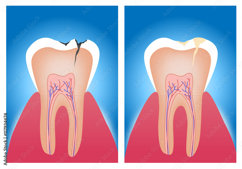 teeth . vector illustration of an amalgam filling before and after teeth teeth . vector illustration of an amalgam filling before and after teeth