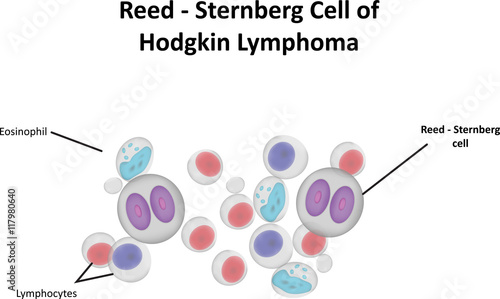 Reed Sternberg Cell