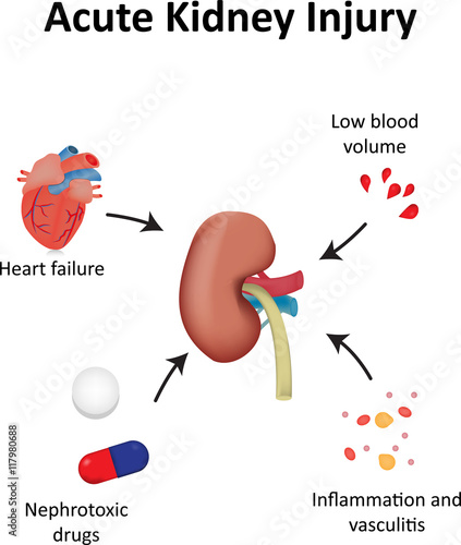 Фотография Acute Kidney Injury