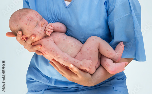 Fotografía Doctor holding a newborn baby which is sick rubella or measles