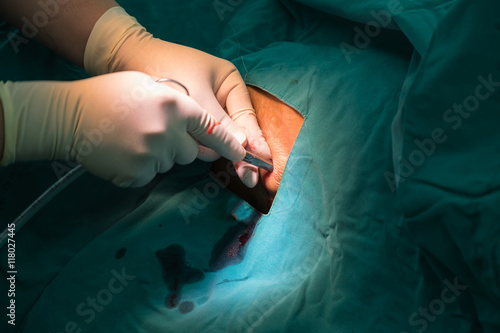Fotografija The doctor put the patient thoracic drainage line.