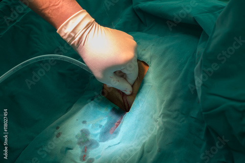 The doctor put the patient thoracic drainage line.