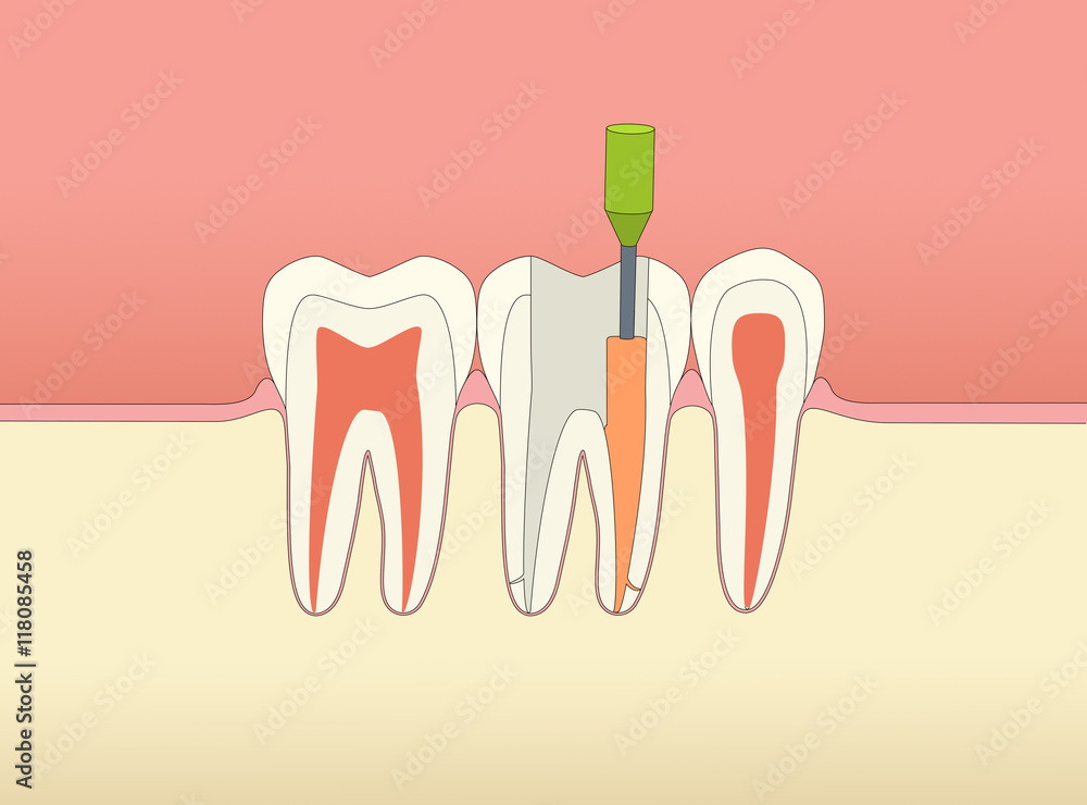 Endodontie Endodontie