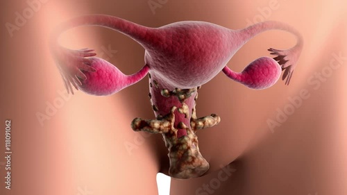 Biomedical visualization of cervical cancer. An infected cell grows & infects other cells of cervix causing tumor, It spreads in & around vagina if not treated. photo