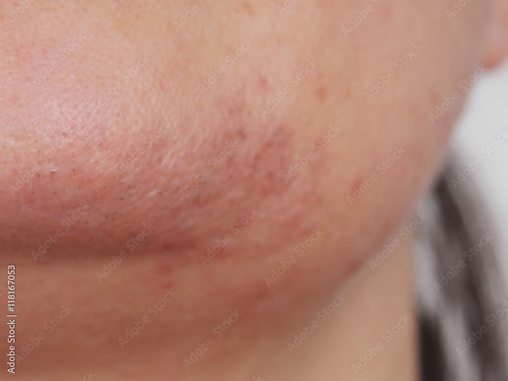 bad skin close-up bad skin close-up