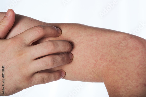 Scratching hand with allergy rash photo