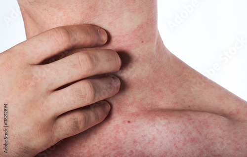 man scratching his neck with rash