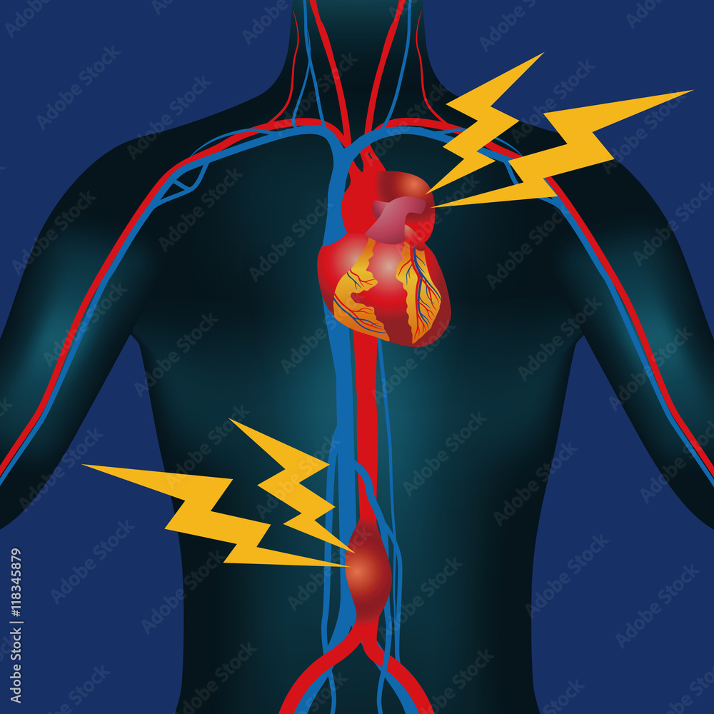 Abdominal Aortic Aneurysm and Thoracic Aortic Aneurysm, human ...