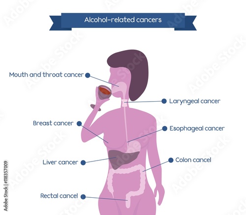 Alcohol related cancers infographics. Woman silhouette drinking wineglass