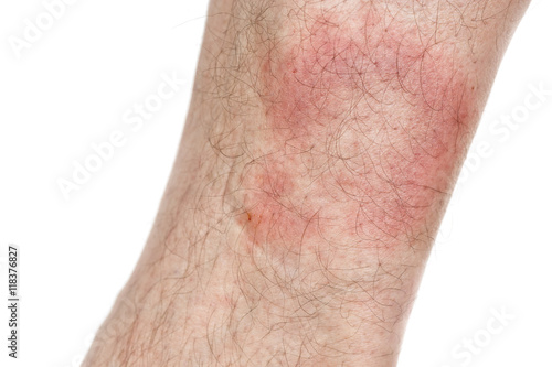 Symptom of Lyme Disease, Circular Expanding Rash, Erythema Migra photo