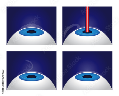lasik vector , eye