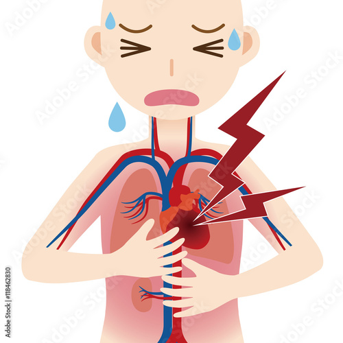 human circulatory system and heart infarction, cardiac infarction, myocardial infarct, simplified anatomical chart