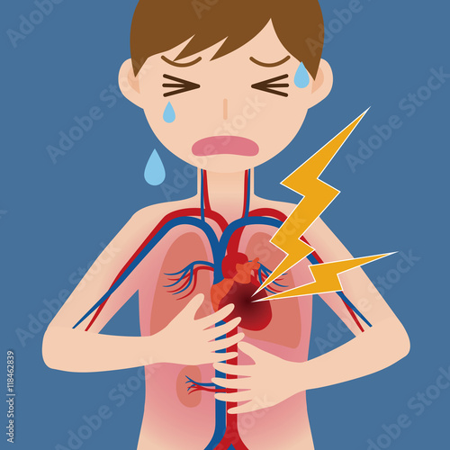 human circulatory system and heart infarction, cardiac infarction, myocardial infarct, simplified anatomical chart