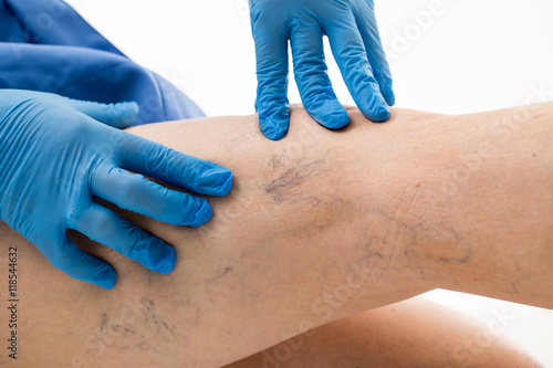 Pajączki naczyniowe. Teleangiektazje. Choroby skóry. 