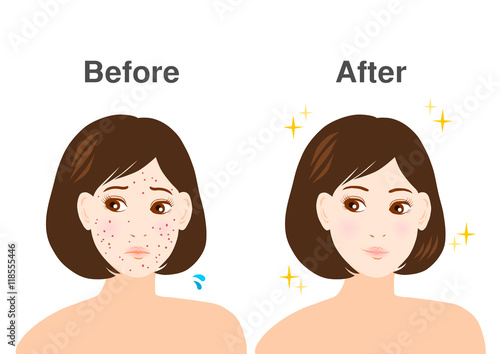 ニキビに悩む女性のイラスト: ビフォーアフター