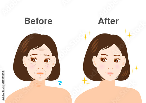 シワ・たるみに悩む女性のイラスト: ビフォーアフター