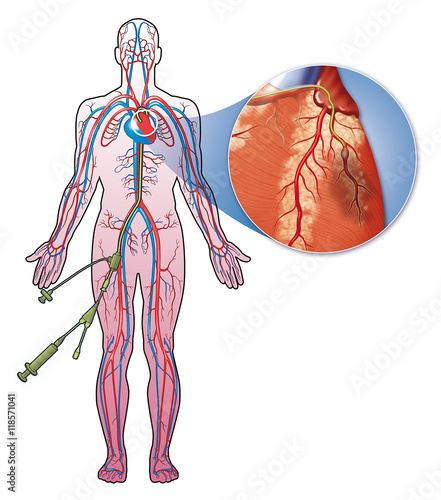 Schema of a coronary catheterization on white