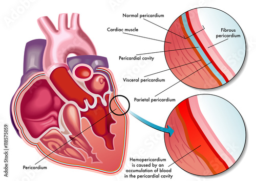 hemopericardium