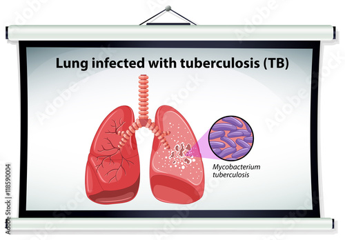 Diagram showing lung cancer