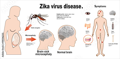 Zika virus symptoms infographics with figures and text