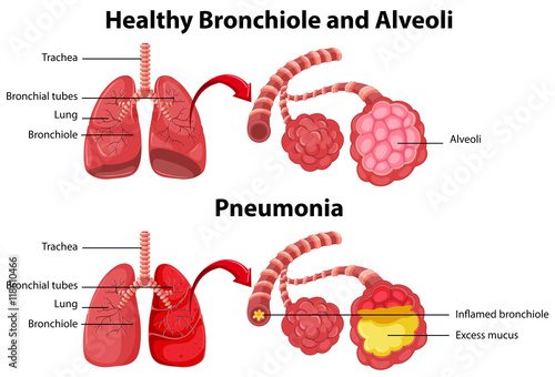 Healthy and unhealthy of human lungs