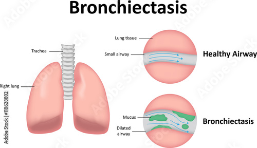 Bronchiectasis Labeled