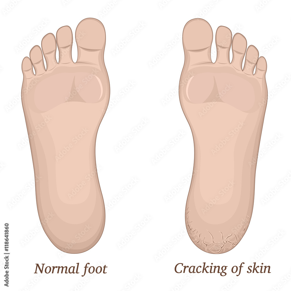 Illustration of healthy feet and feet with cracks on the heel Illustration of healthy feet and feet with cracks on the heel
