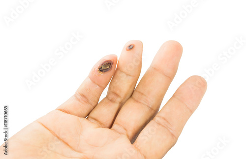 blisters on finger caused by electric shock