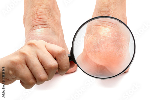 Fotografia Cracked heels and foot fungus  on white background