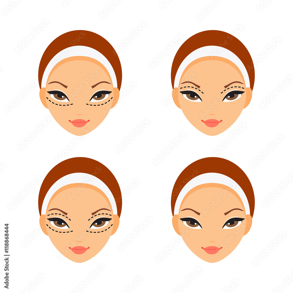 Blepharoplasty. Vector illustration Blepharoplasty. Vector illustration