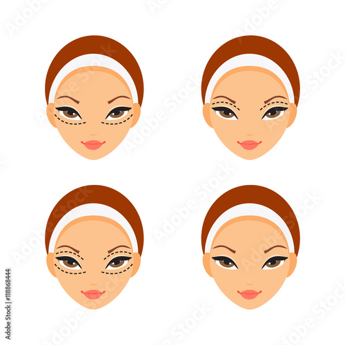 Blepharoplasty. Vector illustration