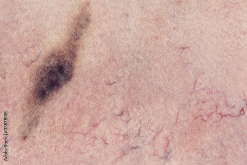 Human skin  with hematoma, vascular problems, couperose