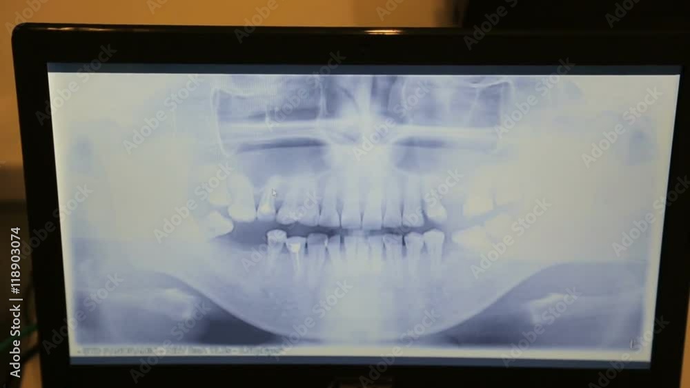 Computer screen shows a panoramic x-ray image of teeth and jaw. Computer screen shows a panoramic x-ray image of teeth and jaw.