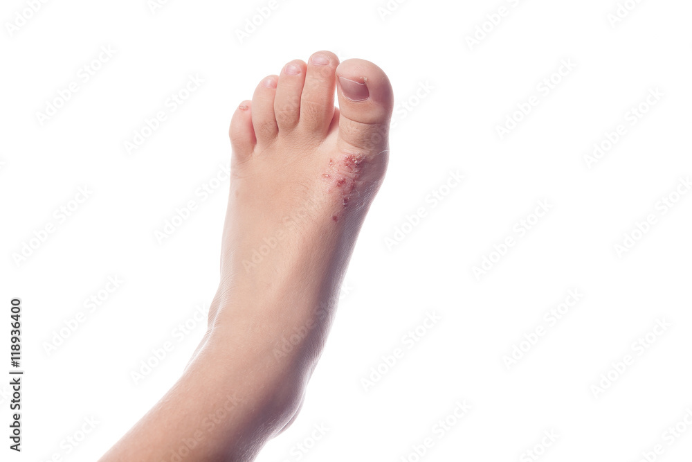 Eczema, atopic dermatitis. Close up of eczema on the skin of the Eczema, atopic dermatitis. Close up of eczema on the skin of the