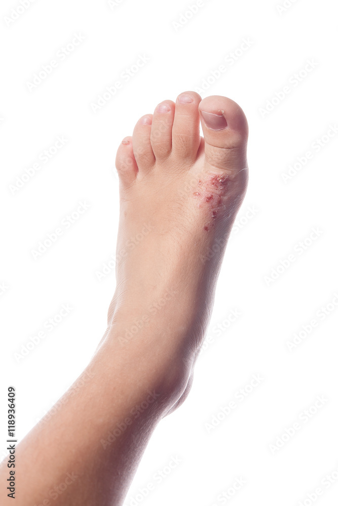 Eczema, atopic dermatitis. Close up of eczema on the skin of the Eczema, atopic dermatitis. Close up of eczema on the skin of the