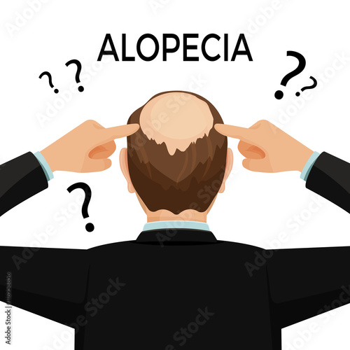 Alopecia concept. Man is showing his hairloss nape.