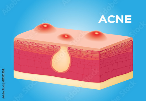 acne on skin anatomy vector , acne box icon