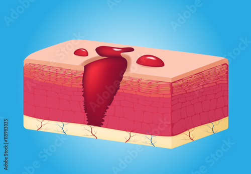 wound skin vector graphic . blood come out of wound