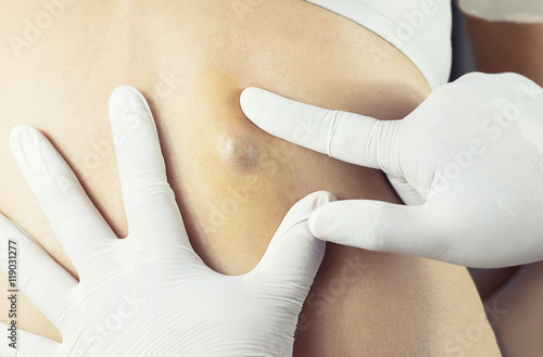 Doctor Diagnosis of the Sebaceous on Woman's Back photo
