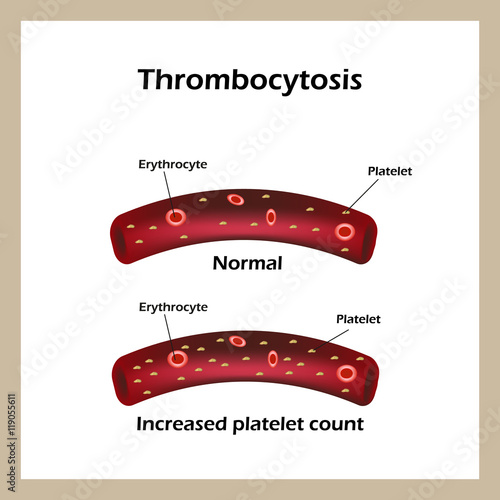 Thrombocytosis. Elevated levels of blood platelets. Infographics. Vector illustration