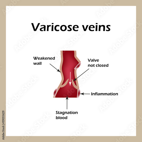 Phlebeurysm. Varicose veins. Venous disease. Infographics. Vector illustration
