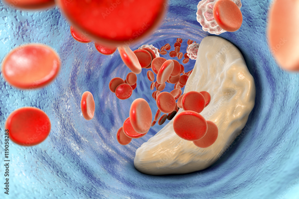 Atheroma plaque inside artery. 3D illustration which can be used for