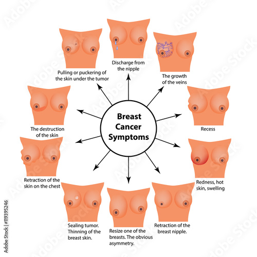 Symptoms of breast cancer. Infographics. Vector illustration on isolated background