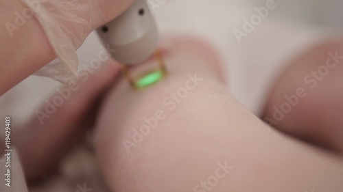 Laser hair removal foot procedure on girl foot