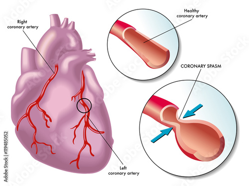 coronary artery spasm