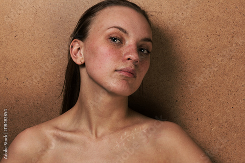 Photo Closeup girl portrait with a scar on a clavicle after operation