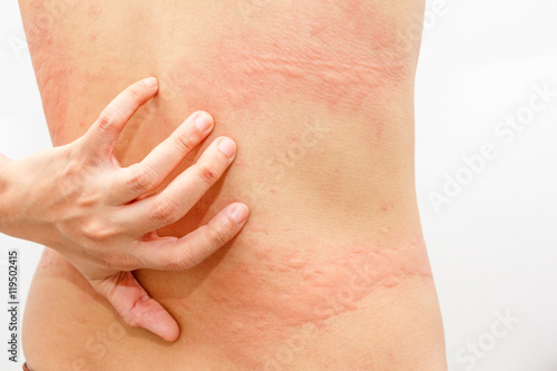 Women with symptoms of itchy urticaria.