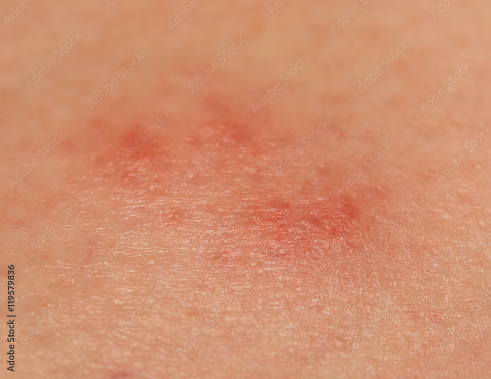 redness of the skin from a mosquito bite redness of the skin from a mosquito bite