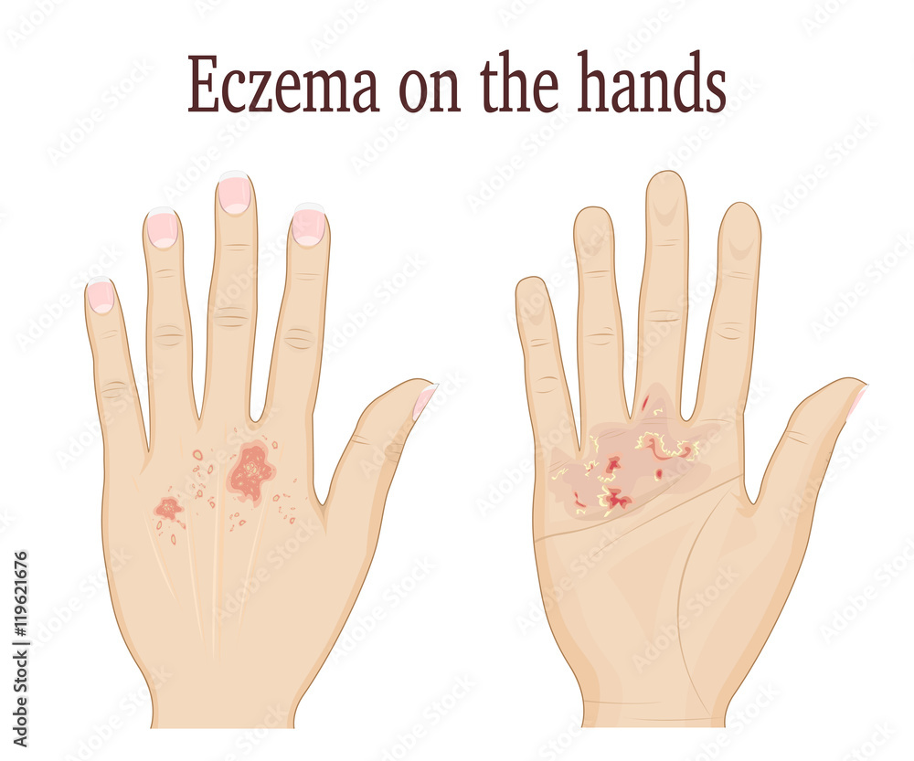 Obraz premium Eczema on a palm and on the back of hand