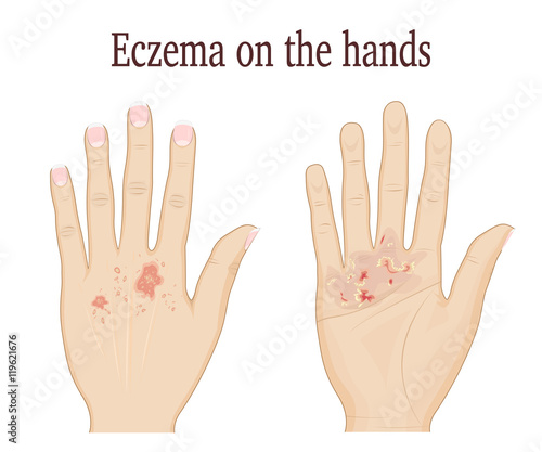 Eczema on a palm and on the back of hand